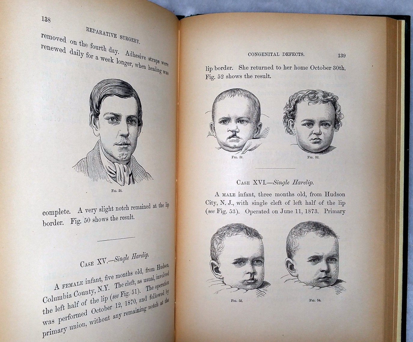 Contributions to Reparative Surgery: Showing It's Application to the Treatment of Deformities, Produced By Destructive Disease or Injury, Congenital Defects From Arrest or Excess of Development; and Cicatricial Contractions From Burns
